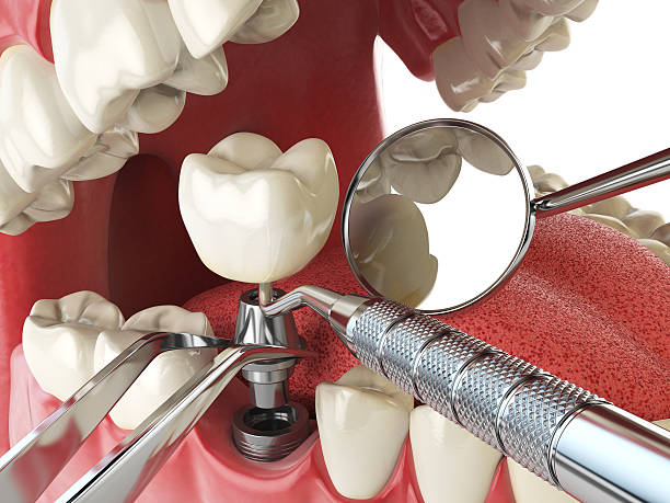 Best Broken or Chipped Tooth Repair in Patrick Springs, VA